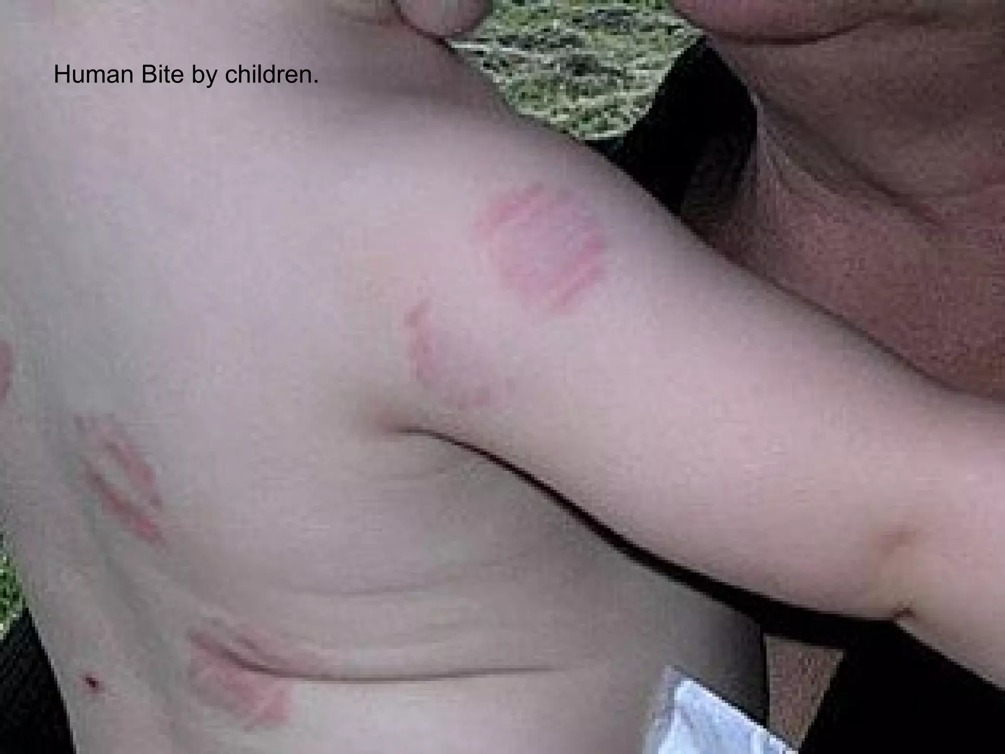 Human Bite by children. 