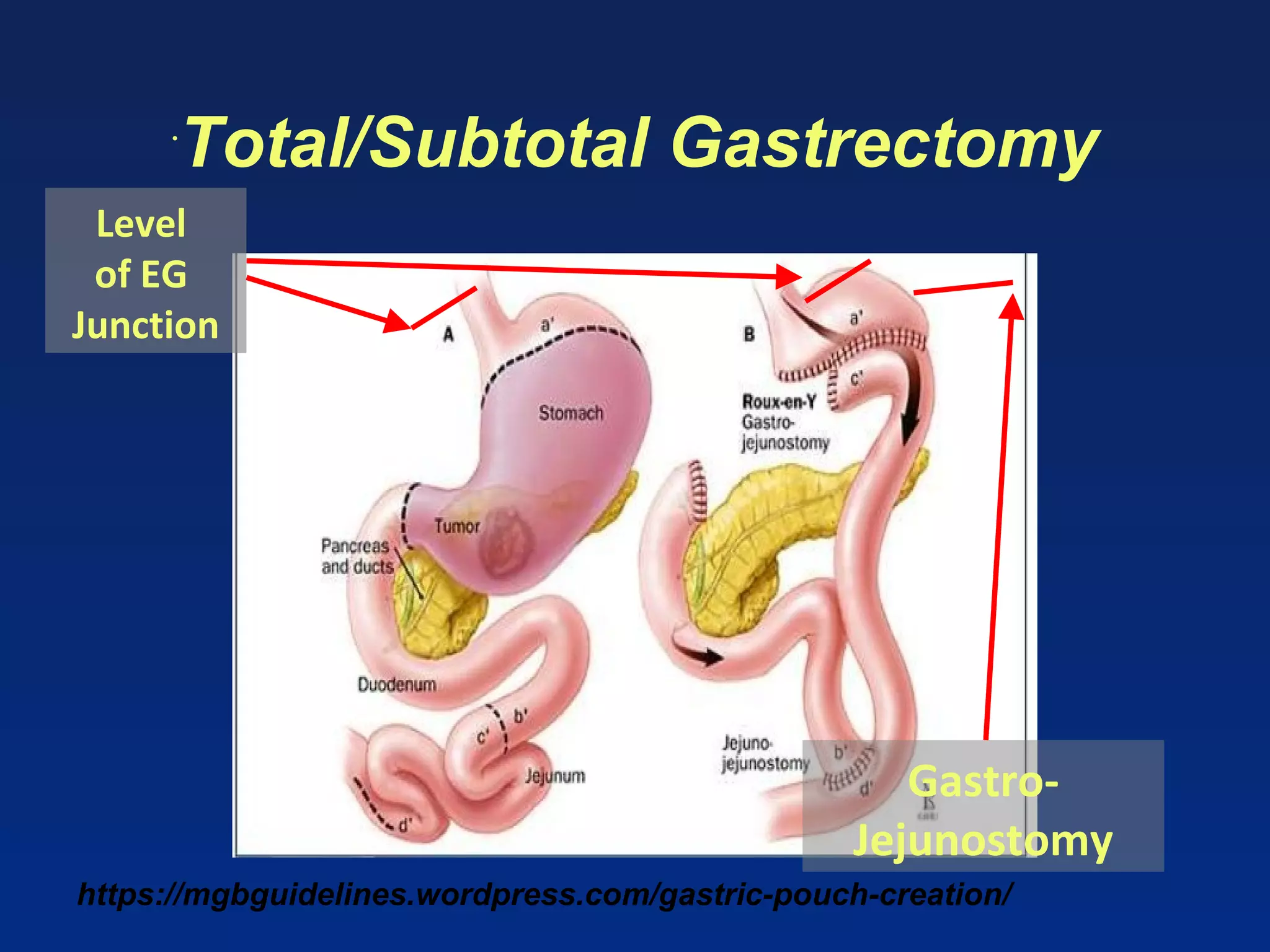 https://mgbguidelines.wordpress.com/gastric-pouch-creation/
•
Total/Subtotal Gastrectomy
Level
of EG
Junction
Gastro-
Jejunostomy
 
