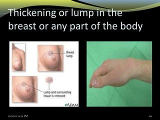 Thickening or lump in the
breast or any part of the body
10/20/12 01:12 PM 101
 