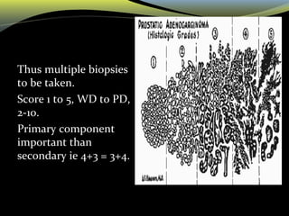 Thus multiple biopsies
to be taken.
Score 1 to 5, WD to PD,
2-10.
Primary component
important than
secondary ie 4+3 = 3+4.
 