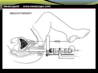 BRACHYTHERAPY
 
