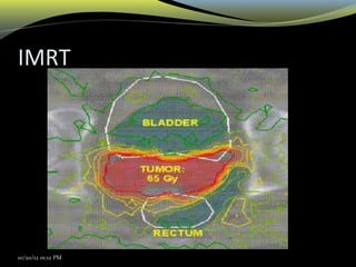IMRT
10/20/12 01:12 PM
 