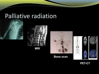 Palliative radiation
Skeletal X-Ray
Bone scan
MRI
PET-CT
 