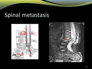 Spinal metastasis
86
 