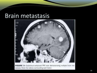 Brain metastasis
88
 