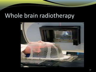 Whole brain radiotherapy
90
 