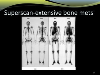 Superscan-extensive bone mets
92
 
