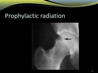 Prophylactic radiation
94
 