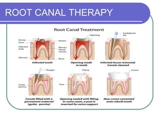 ROOT CANAL THERAPY
 