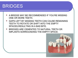 BRIDGES
 A BRIDGE MAY BE RECOMMENDED IF YOU’RE MISSING
ONE OR MORE TEETH.
 GAPS LEFT BY MISSING TEETH CAN CAUSE REMAINING
TEETH TO ROTATE OR SHIFT INTO THE EMPTY
SPACES,RESULTING IN A BAD BITE.
 BRIDGES ARE CEMENTED TO NATURAL TEETH OR
IMPLANTS SORROUNDING THE EMPTY SPACE.
 