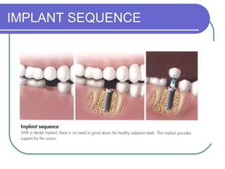IMPLANT SEQUENCE
 
