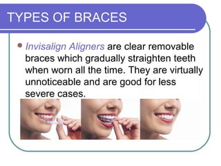 TYPES OF BRACES
Invisalign Aligners are clear removable
braces which gradually straighten teeth
when worn all the time. They are virtually
unnoticeable and are good for less
severe cases.
 