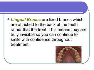Lingual Braces are fixed braces which
are attached to the back of the teeth
rather that the front. This means they are
truly invisible so you can continue to
smile with confidence throughout
treatment.
 