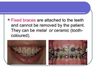 Fixed braces are attached to the teeth
and cannot be removed by the patient.
They can be metal or ceramic (tooth-
coloured).
 