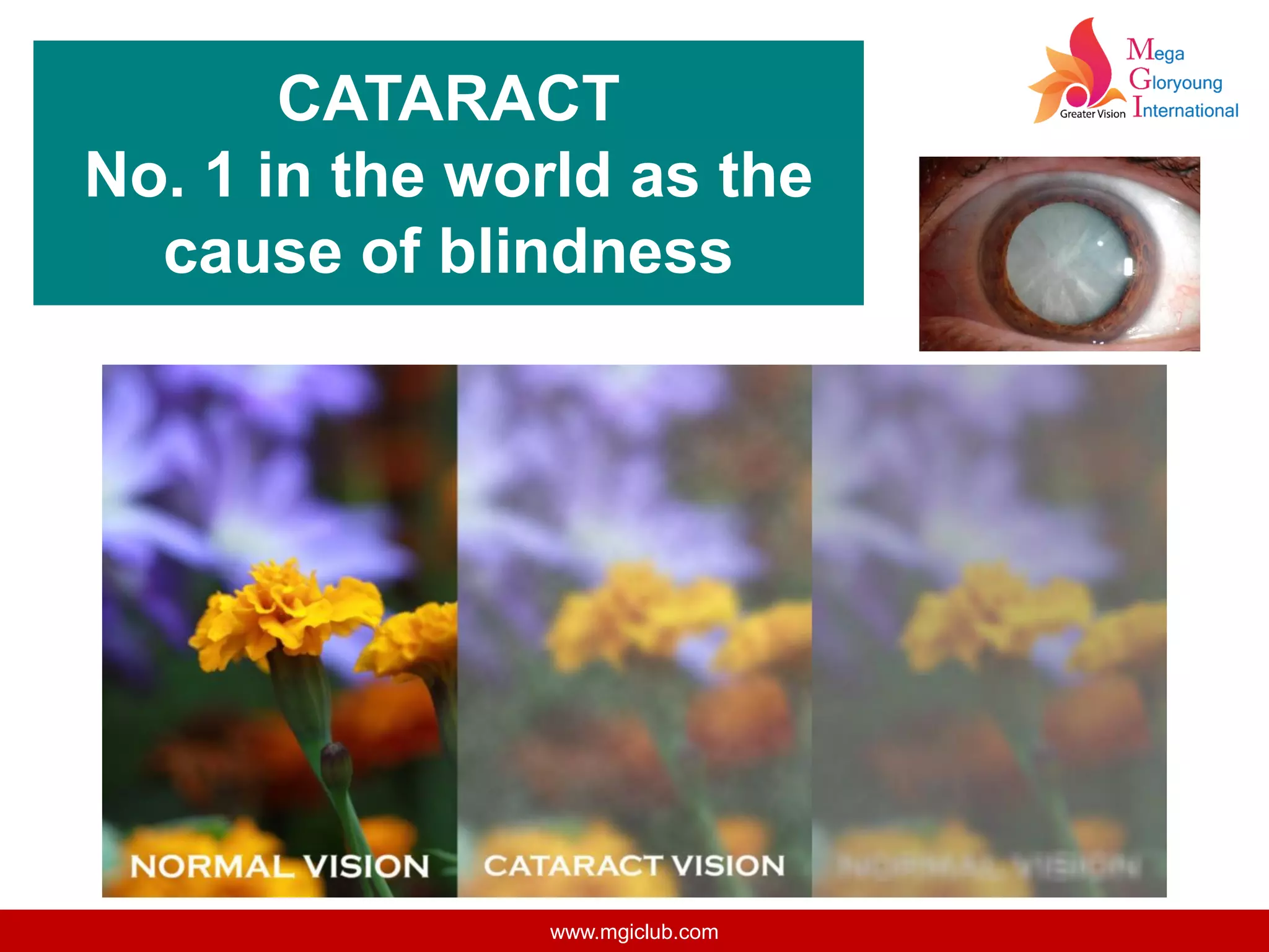 CATARACT
No. 1 in the world as the
cause of blindness
www.mgiclub.com
 