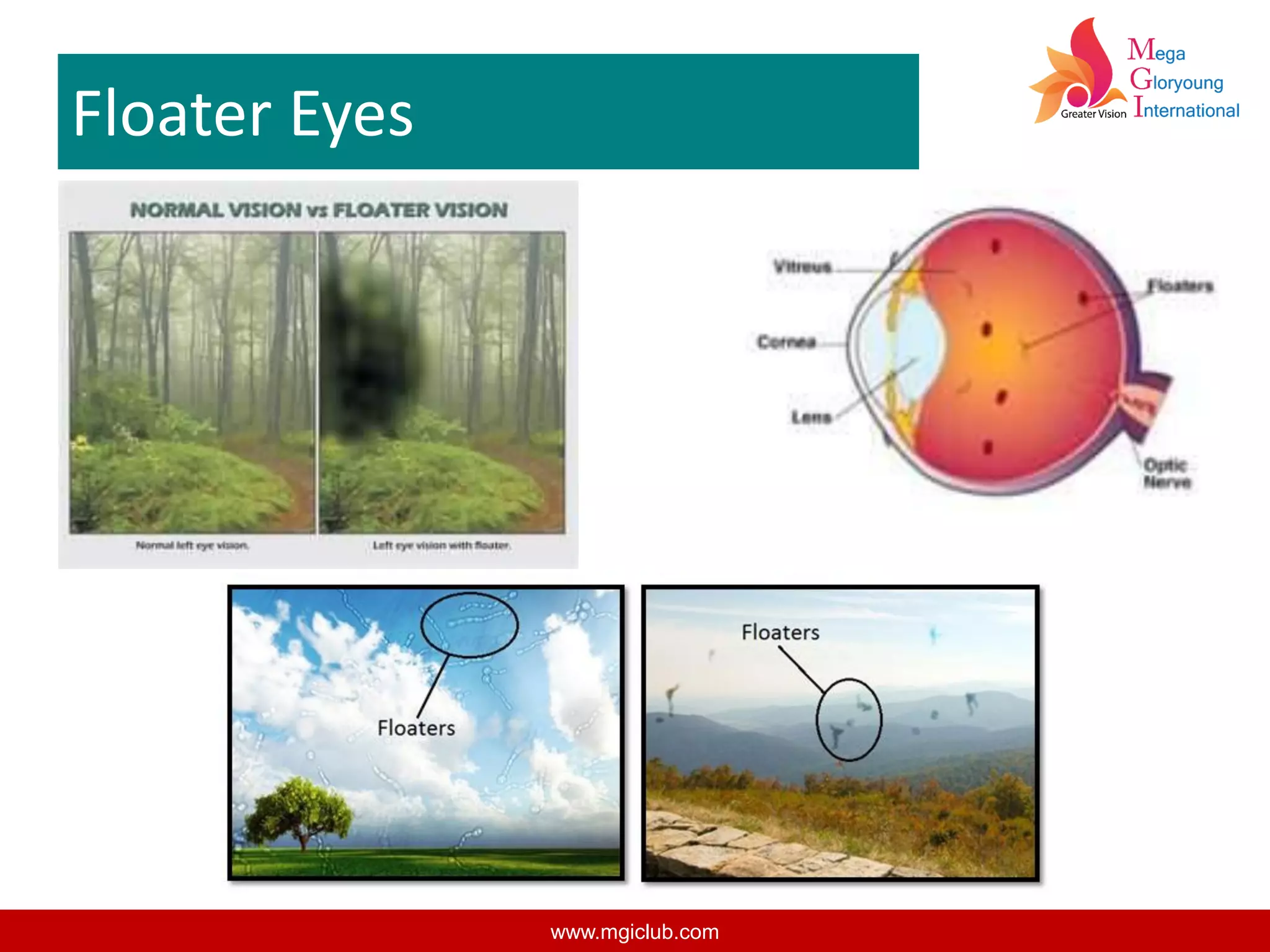Floater Eyes
www.mgiclub.com
 