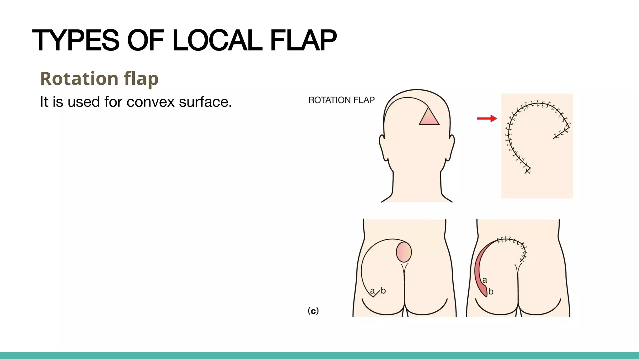 Different types of Skin graft & flap.pptx