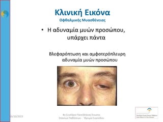 16/10/2015
8ο Συνέδριο Πανελλήνιας Ένωσης
Σπανίων Παθήσεων - Ίδρυμα Ευγενίδου
23
• Η αδυναμία μυών προσώπου,
υπάρχει πάντα
Βλεφαρόπτωση και αμφοτερόπλευρη
αδυναμία μυών προσώπου
Κλινική Εικόνα
Οφθαλμικής Μυασθένειας
 
