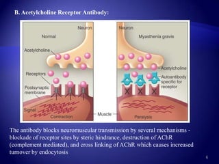 B. Acetylcholine Receptor Antibody:




The antibody blocks neuromuscular transmission by several mechanisms -
blockade of receptor sites by steric hindrance, destruction of AChR
(complement mediated), and cross linking of AChR which causes increased
turnover by endocytosis
                                                                          6
 
