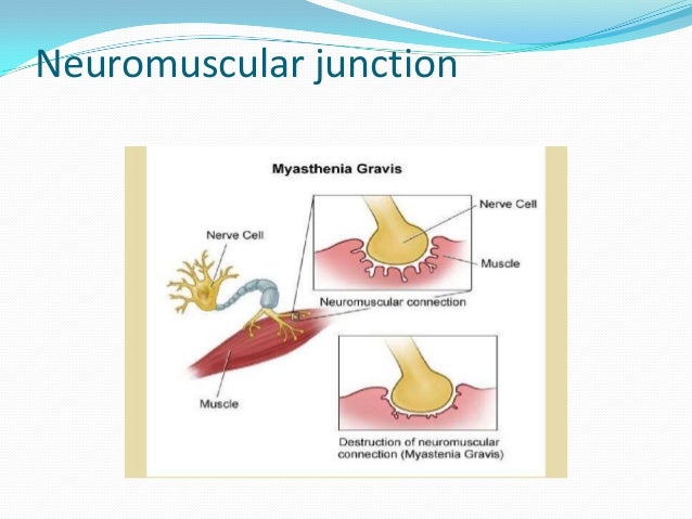 occurs chemical pregnancy how a Pregnancy Myasthenia Gravis. young girl in with