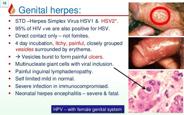 Herpes Pictures & Symptoms of Herpes Simplex