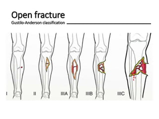 Anderson Classification Management of common fractures in ED | PPTX