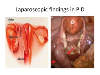 Laparoscopic findings in PID
 