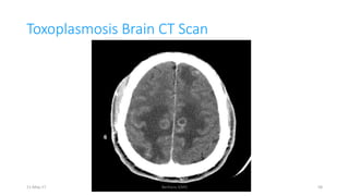 Toxoplasmosis Brain CT Scan
11-May-17 Berhanu S(MI) 58
 