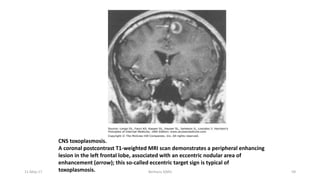 CNS toxoplasmosis.
A coronal postcontrast T1-weighted MRI scan demonstrates a peripheral enhancing
lesion in the left frontal lobe, associated with an eccentric nodular area of
enhancement (arrow); this so-called eccentric target sign is typical of
toxoplasmosis.
11-May-17 Berhanu S(MI) 59
 