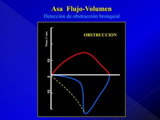 Asa Flujo-Volumen

10

0

10

Flow, l / sec

Detección de obstrucción bronquial

OBSTRUCCION

 