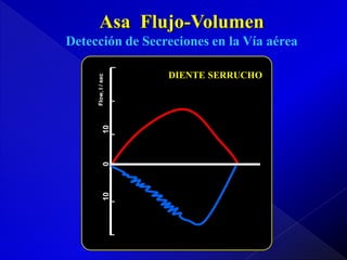 Asa Flujo-Volumen

10

0

10

Flow, l / sec

Detección de Secreciones en la Vía aérea
DIENTE SERRUCHO

 