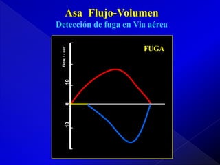 Asa Flujo-Volumen

10

0

10

Flow, l / sec

Detección de fuga en Via aérea
FUGA

 