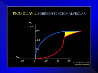 PICO DE AVE: SOBREDISTENCION ALVEOLAR
VT
LITROS

0.6

0.4

0.2

Paw
20

0

20

40

60

 