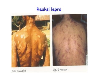 Reaksi lepra
 