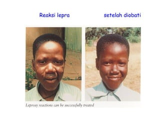 Reaksi lepra setelah diobati
 