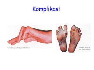 Komplikasi
 