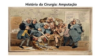 História da Cirurgia: Amputação
 