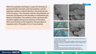 The Role Of Neurointervention In Acute Ischemic Stroke | PPTX