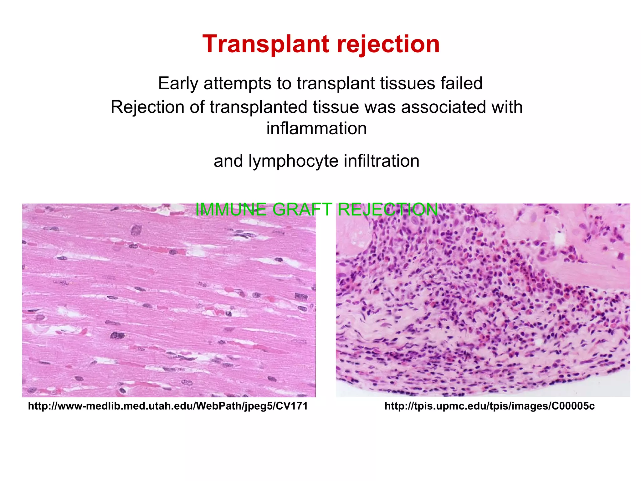 Transplant rejection Early attempts to transplant tissues failed http://www-medlib.med.utah.edu/WebPath/jpeg5/CV171 http://tpis.upmc.edu/tpis/images/C00005c Rejection of transplanted tissue was associated with inflammation and lymphocyte infiltration IMMUNE GRAFT REJECTION 