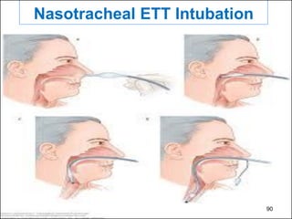 MHG1004-Lect 6-Assisting Dr in Definitive Airway Mx-intubation ...