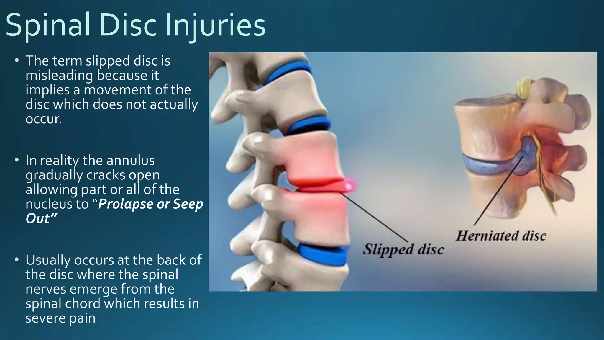 Spinal Disc Injuries
 