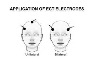 APPLICATION OF ECT ELECTRODES
 