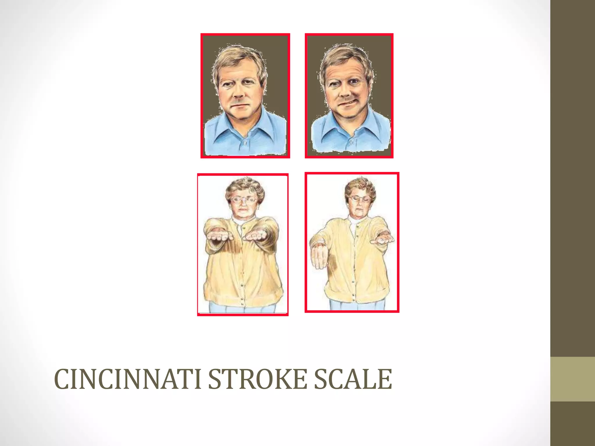 CINCINNATI STROKE SCALE
 