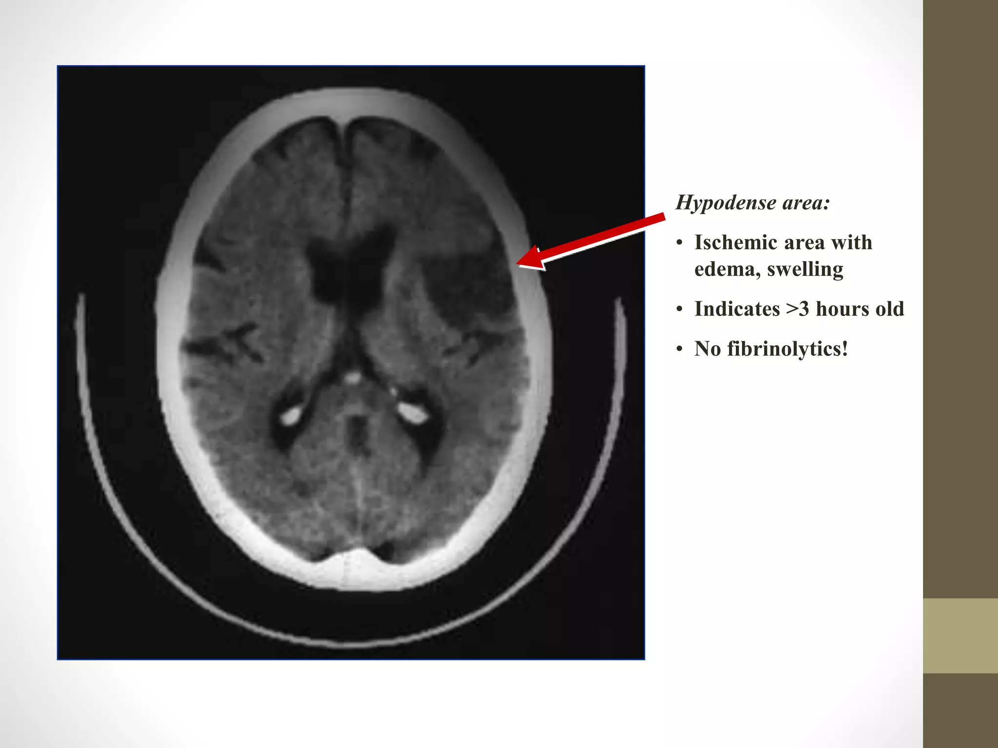 Hypodense area:
• Ischemic area with
edema, swelling
• Indicates >3 hours old
• No fibrinolytics!
 