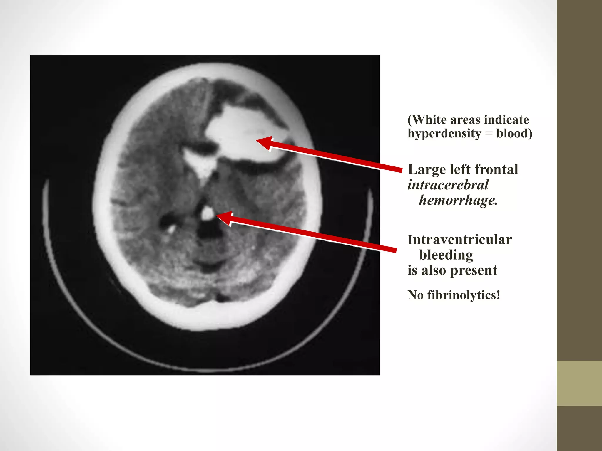 (White areas indicate
hyperdensity = blood)
Large left frontal
intracerebral
hemorrhage.
Intraventricular
bleeding
is also present
No fibrinolytics!
 