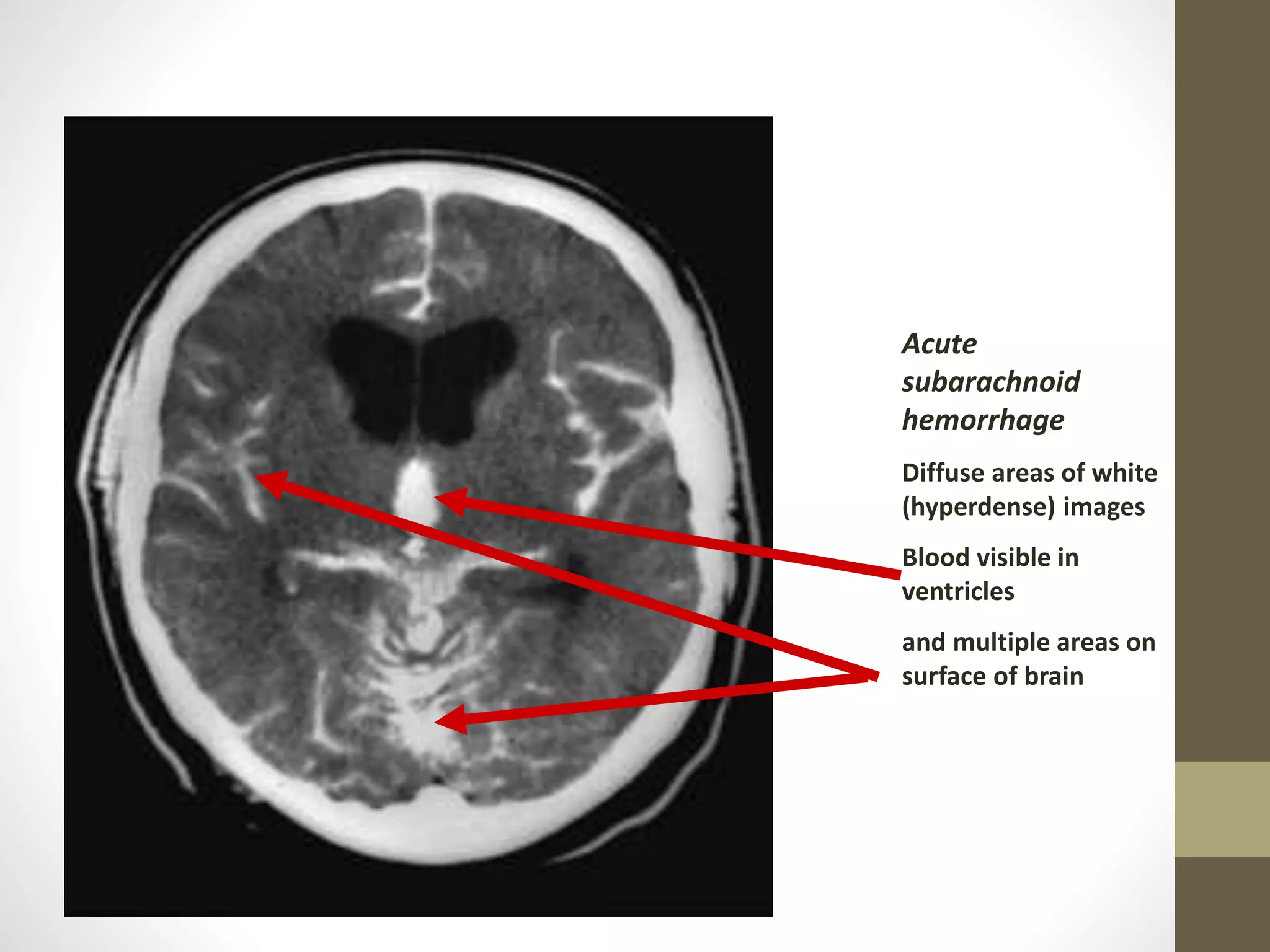 Acute
subarachnoid
hemorrhage
Diffuse areas of white
(hyperdense) images
Blood visible in
ventricles
and multiple areas on
surface of brain
 