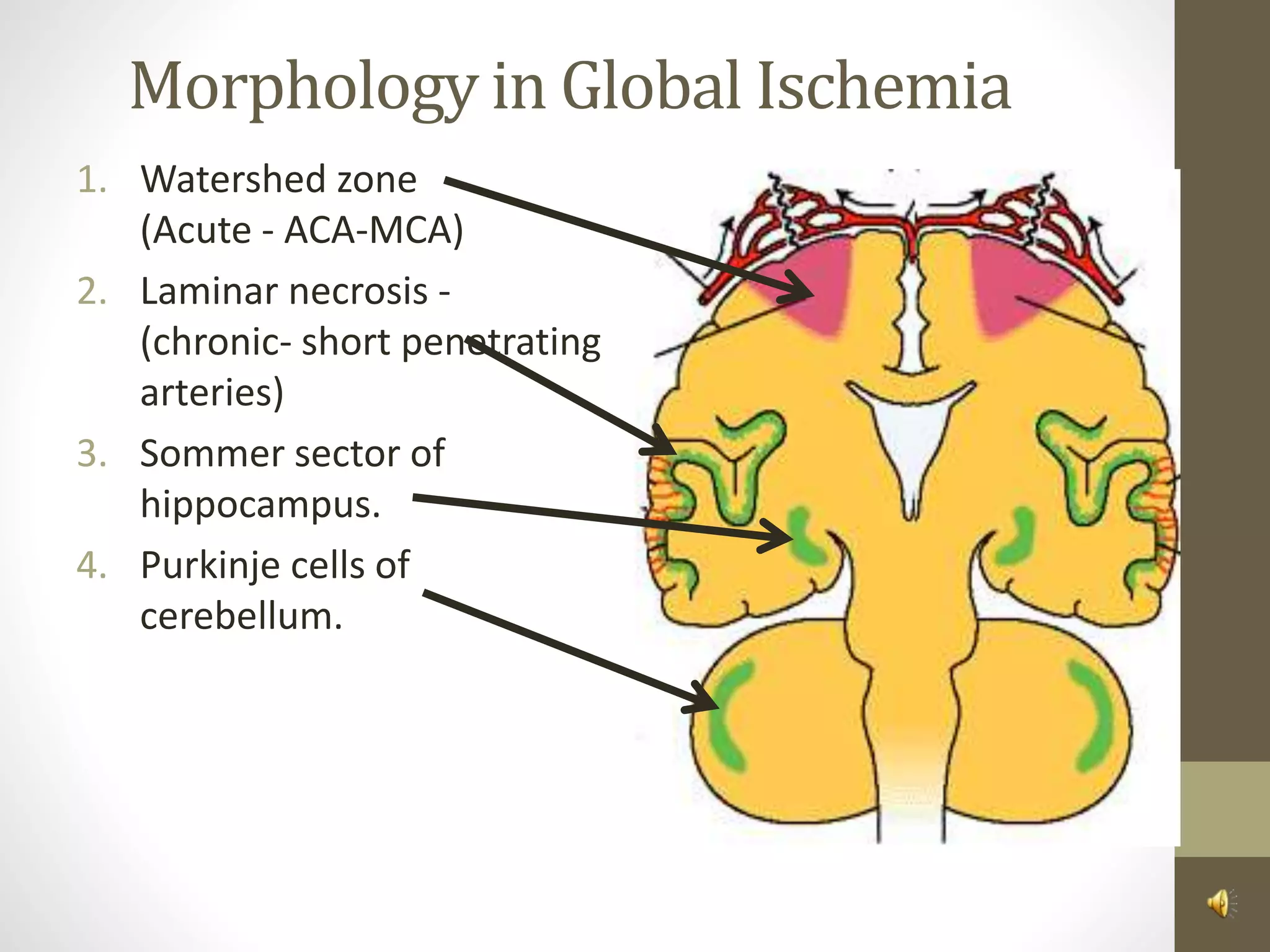 Morphology in Global Ischemia
1. Watershed zone
(Acute - ACA-MCA)
2. Laminar necrosis -
(chronic- short penetrating
arteries)
3. Sommer sector of
hippocampus.
4. Purkinje cells of
cerebellum.
 