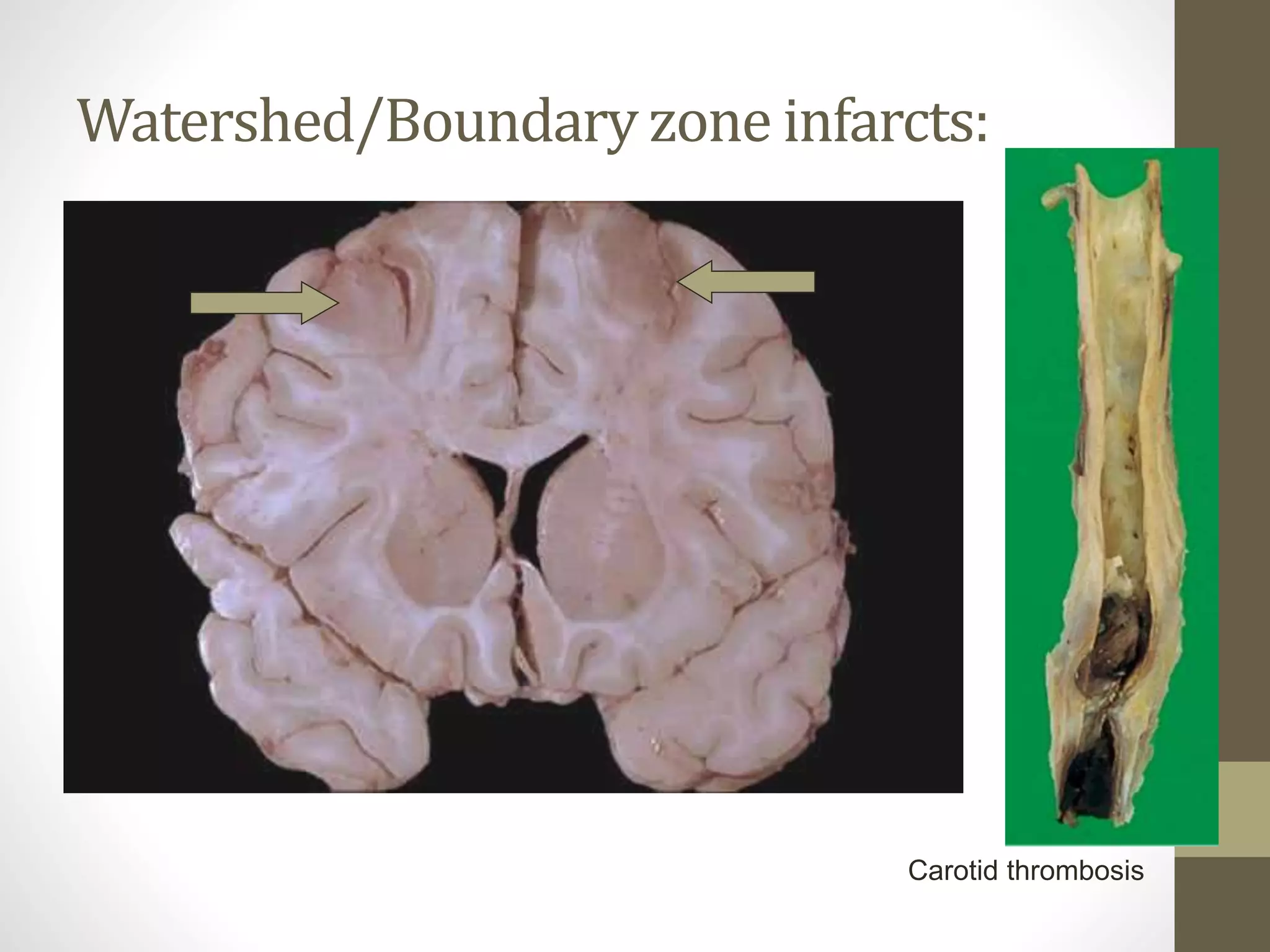 Watershed/Boundary zone infarcts:
Carotid thrombosis
 