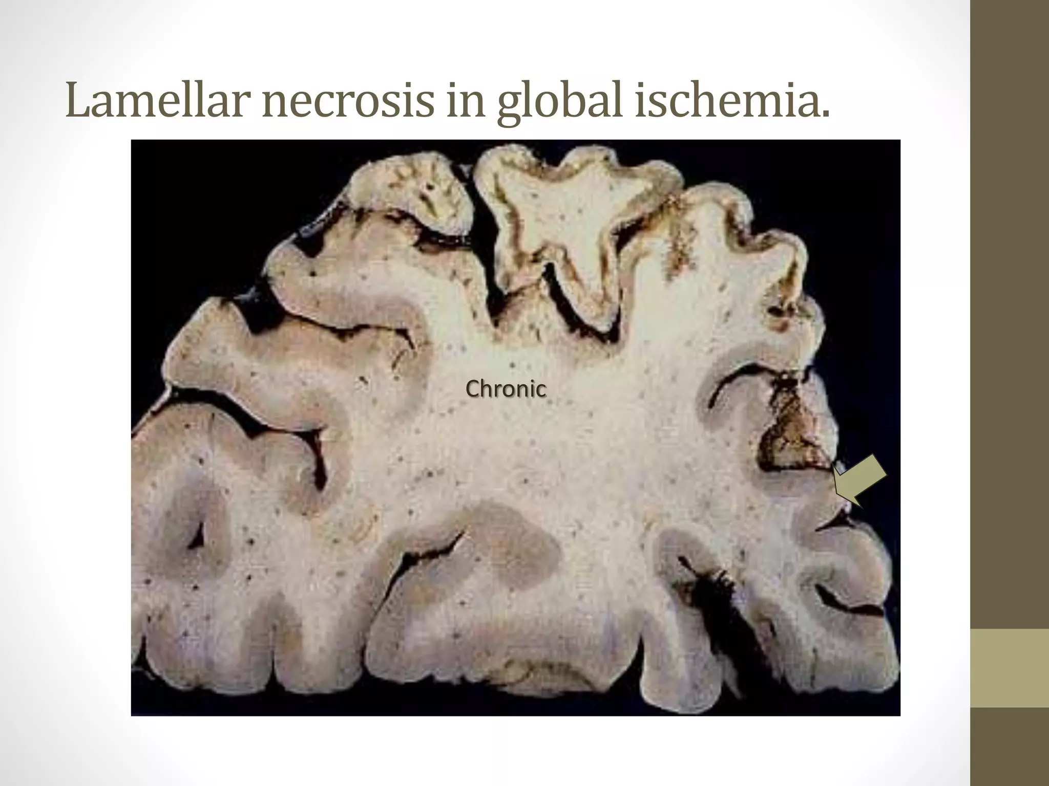 Lamellar necrosis in global ischemia.
Chronic
 