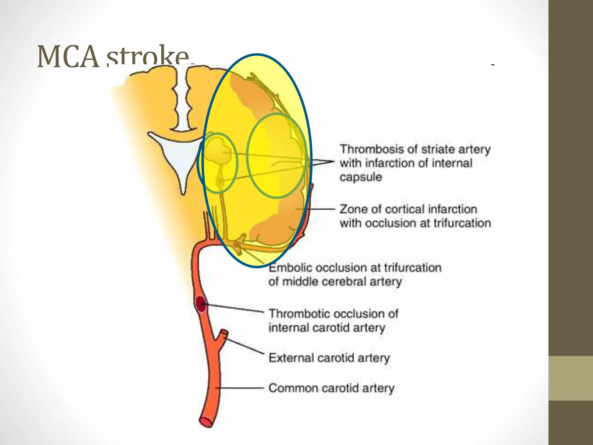 MCA stroke.
 